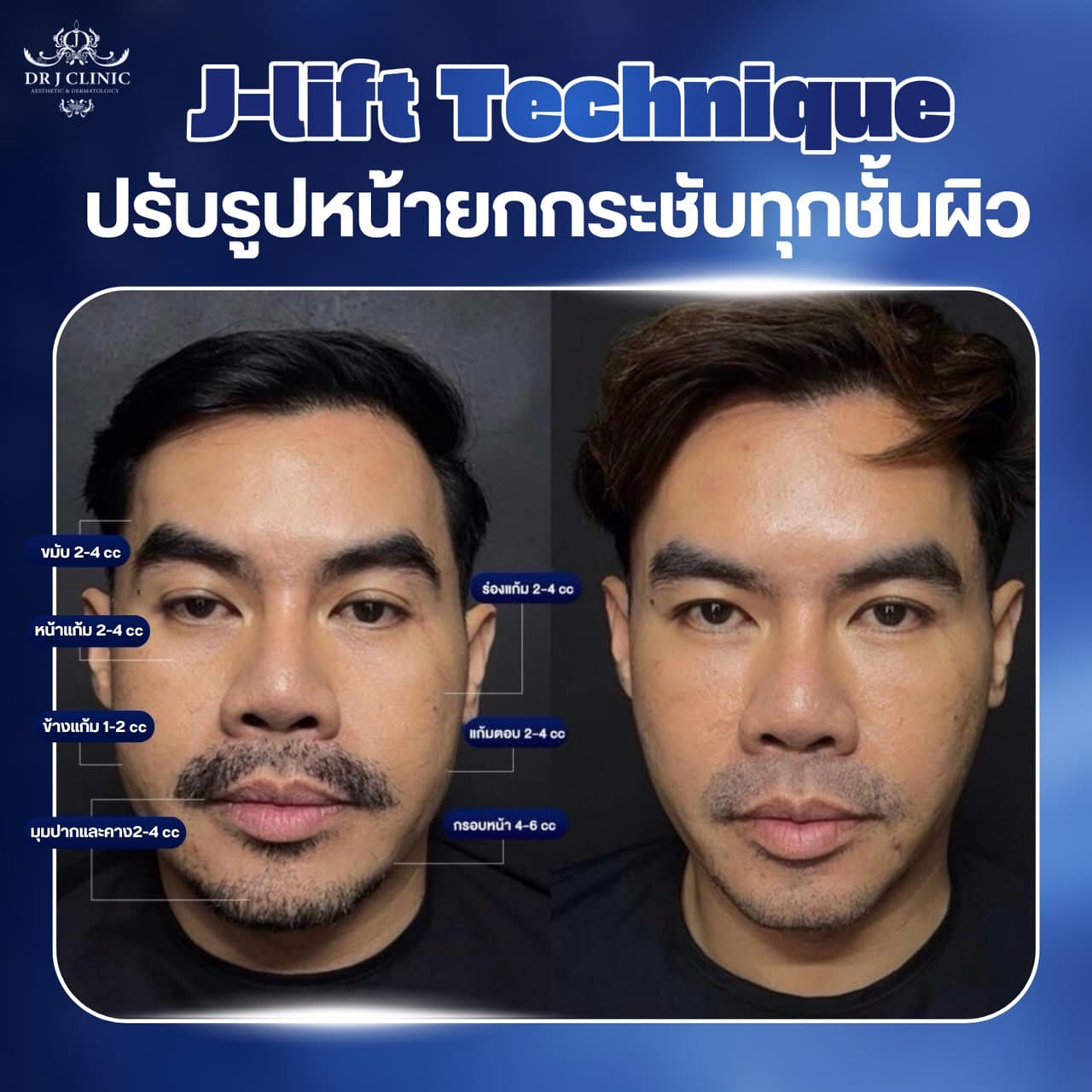 Dr.J Clinic เปิดบริการถึงเที่ยงคืน เอาใจสายทำงานดึกและคนที่ว่างหลังเลิกงาน ตั้งแต่เวลา 10:00–24:00 ให้บริการครบทั้งฟิลเลอร์ โบท็อกซ์ ร้อยไหม Biostimulator และ Ulthera โดยทีมแพทย์ผู้เชี่ยวชาญ ใจกลางเมืองพระราม 3 ภาพรีวิวก่อนหลังทำจริง