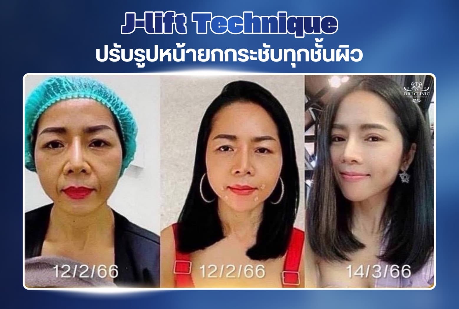 รูปก่อนและหลังปรับรูปหน้าด้วย Definisse ที่ Dr. J Clinic – ยกกระชับหน้า เติมเต็มร่องแก้ม ปรับรูปคางและกรอบหน้าโดยใช้เทคนิค XTR ไม่ใช้ฟิลเลอร์ เห็นผลทันที