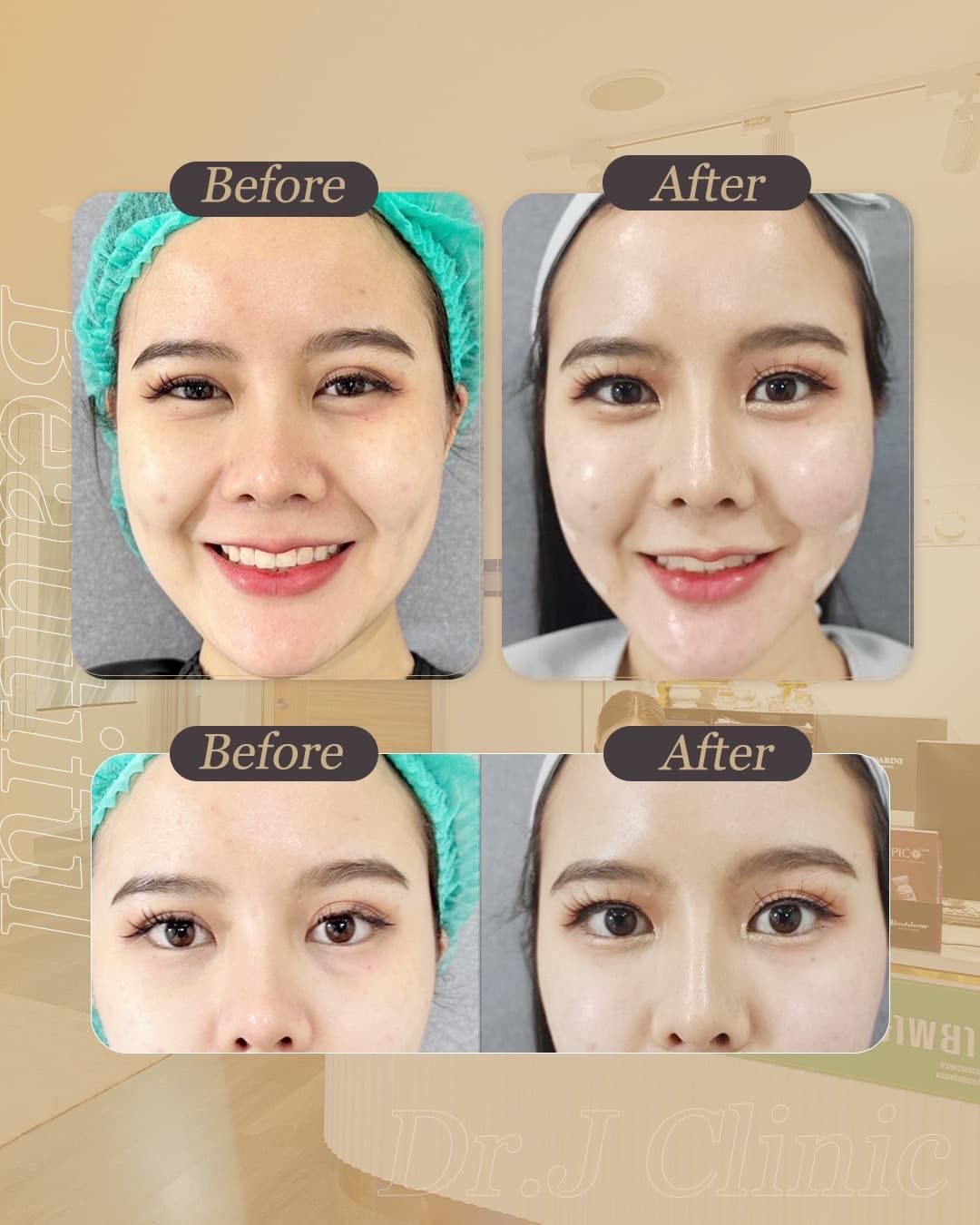 รูปก่อนและหลังปรับรูปหน้าด้วย Definisse ที่ Dr. J Clinic – ฟิลเลอร์ล็อคจุดสำคัญเพื่อความเป๊ะ ยกกระชับ ปรับรูปหน้าให้ดูเป็นธรรมชาติและสมบูรณ์แบบ ด้วยเทคนิค XTR